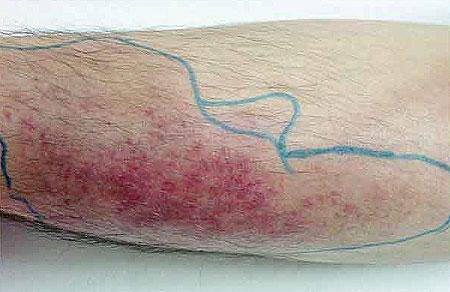 蜂窝织炎是由脚气引发的一种炎症,大多发生在脚气的病灶处.