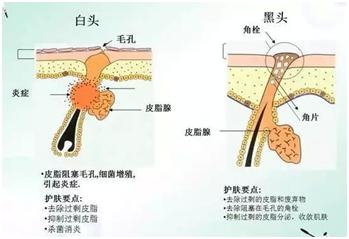 臉上的粉刺栓怎麼護理才會變少?