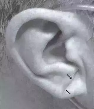 耳垂冠状沟图片