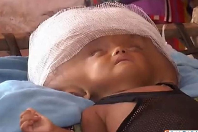 埃及女婴头部寄生胎图片