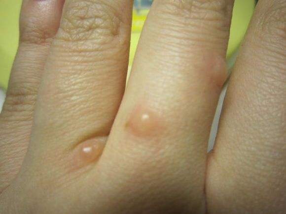 水泡型湿疹的症状图片图片