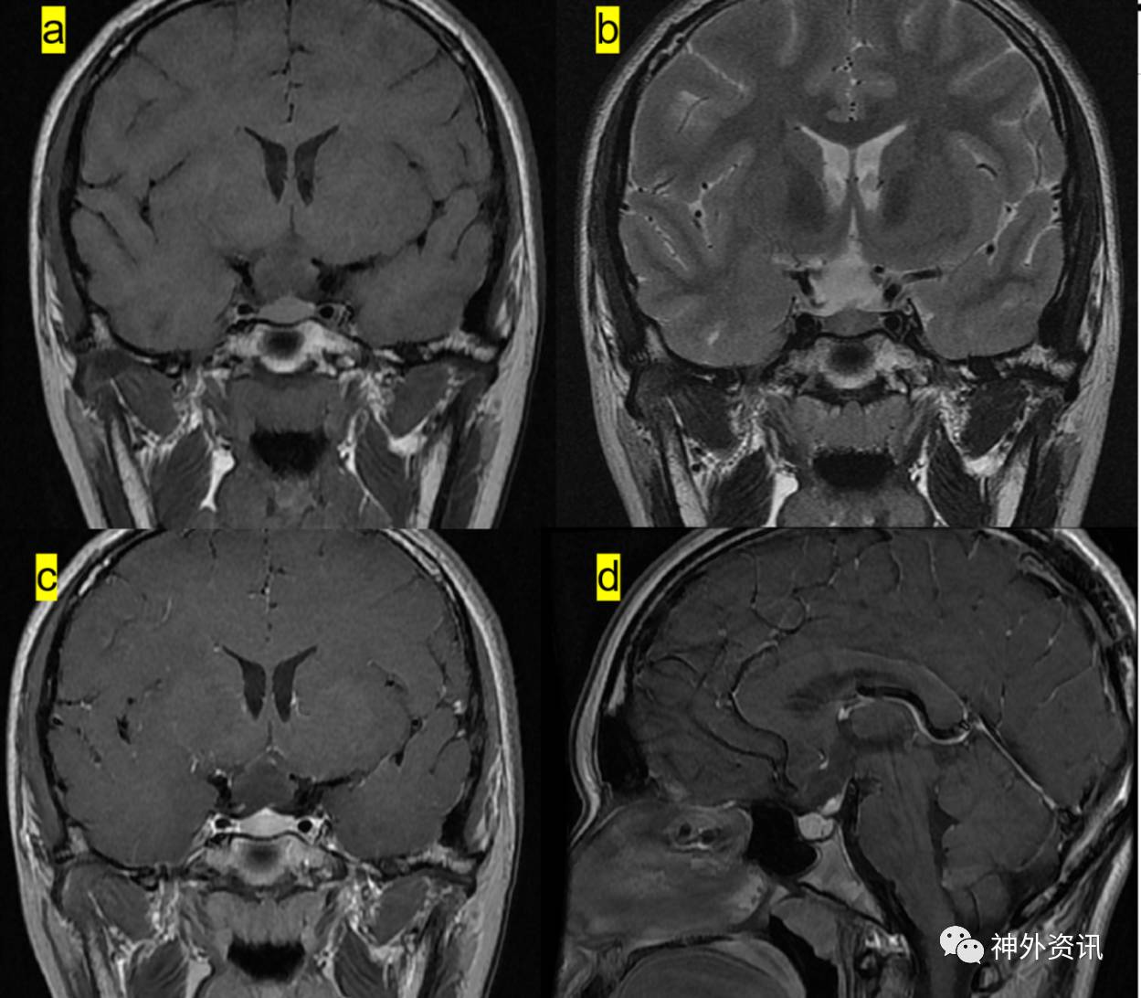 病例討論| 浙二神外週刊(第92期)---鞍上毛細胞黏液樣星形細胞瘤伴
