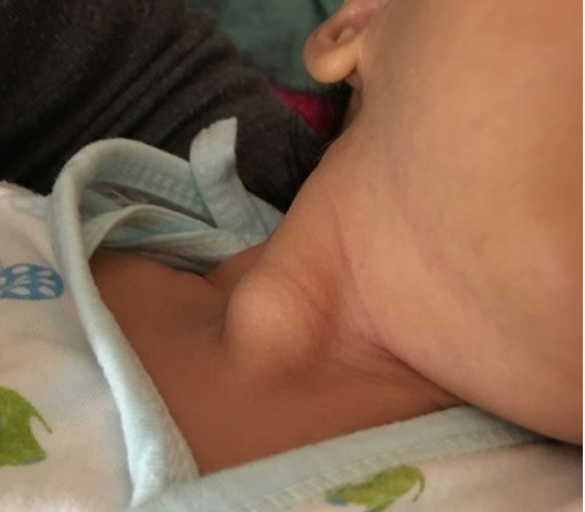 胸锁乳突肌位置婴儿图片