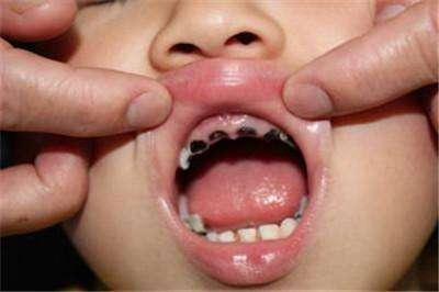 为什么小孩子的牙齿更容易烂?