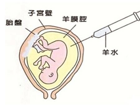 10,妊娠病-10,羊水異常