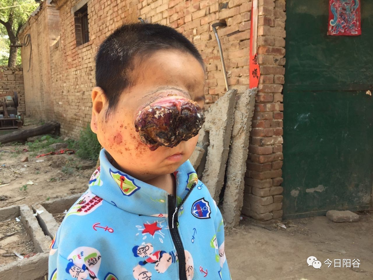 阳谷6岁男孩李正路眼睛上长了一个肿瘤病情牵挂着所有人的心