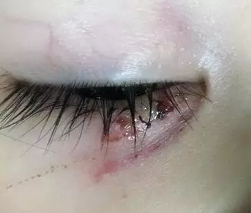 小朋友眼睛受伤的图片图片