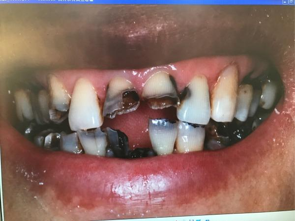 牙医碰见最烂的牙齿到底有多烂?