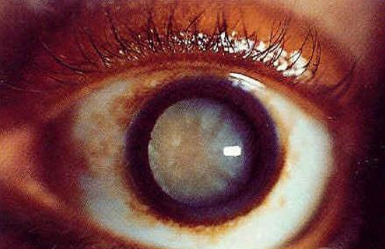 眼睛白内障治疗方法有哪些老人得了白内障怎么治