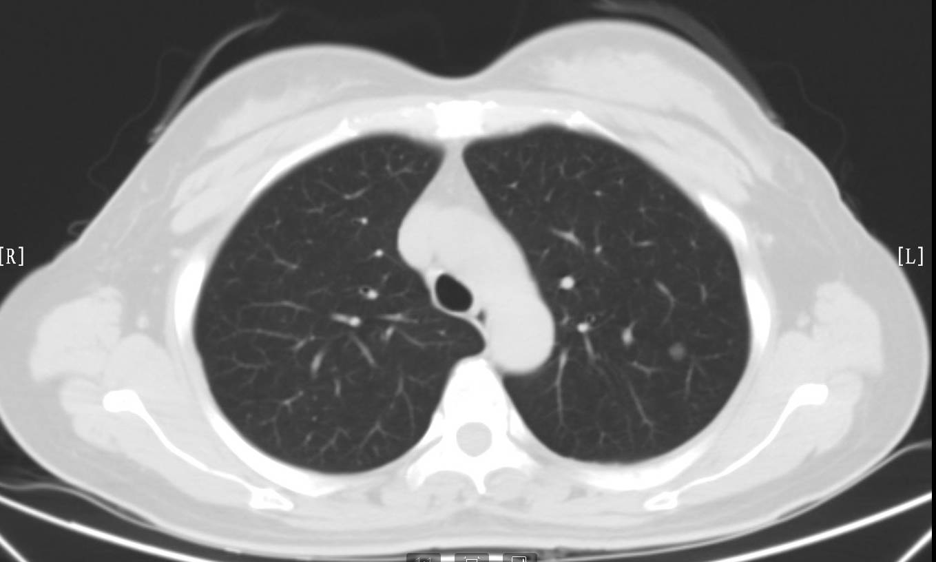 低剂量ct,肺癌早期筛查第一选择