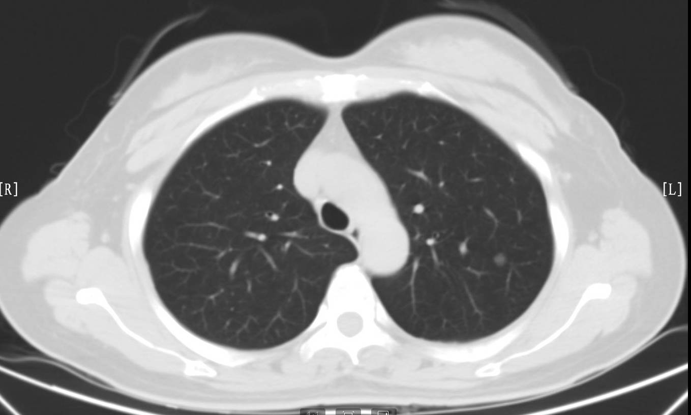 肺癌早期症状ct图片图片