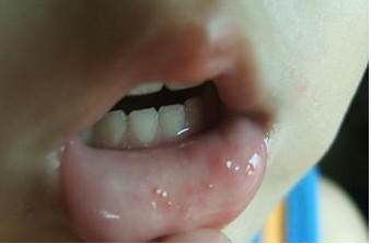 3嘴唇起泡,口角溃疡手足口病,鹅口疮,疱疹性咽峡炎等疾病都会引起宝宝