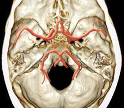 大脑动脉环图片图片