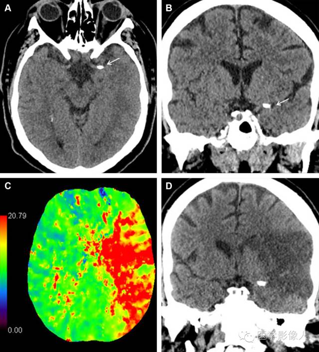 脑梗死影像学表现图片