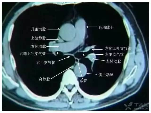 锁骨下动脉ct图片