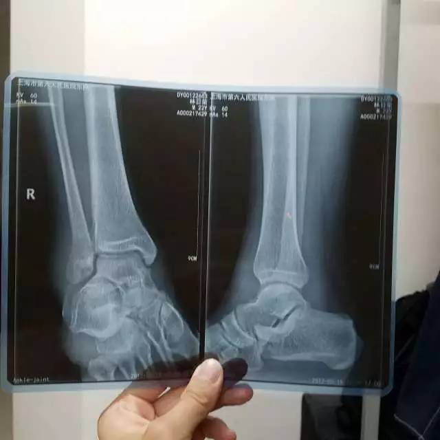 脚踝骨裂诊断证明图片