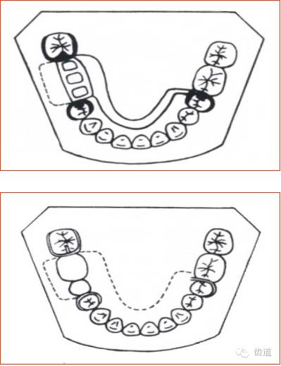 肯氏三类义齿设计图片图片