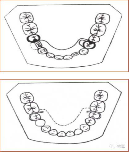 肯氏三类义齿设计图片图片