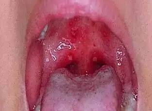 疱疹性咽峡炎的症状图片