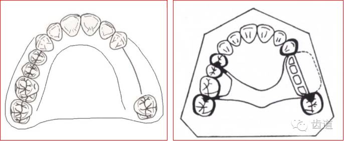 可摘局部义齿的肯氏kennedy分类及设计