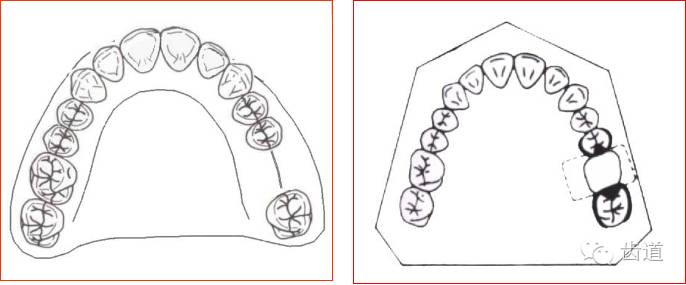 肯氏三类义齿设计图片图片