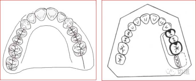 肯氏三类义齿设计图片图片