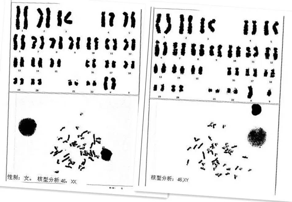 核型46xy图片