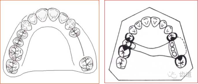 面支承型稳定设计:个别后牙缺失:线支承型多个后牙缺失:双侧设计连接