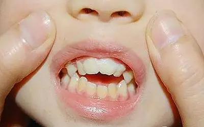 孩子牙齿不齐图片