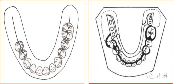 可摘局部义齿的肯氏kennedy分类及设计