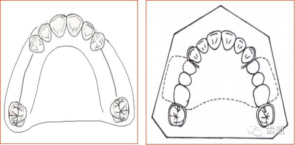 肯氏三类义齿设计图片图片