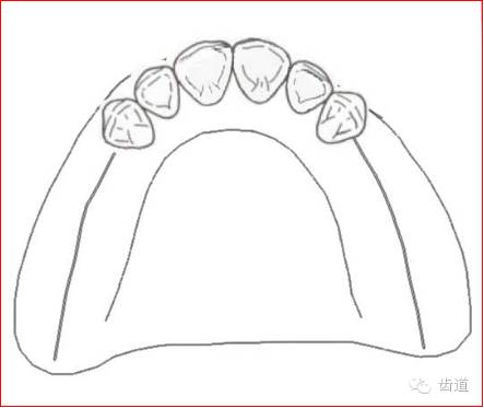 肯氏三类义齿设计图片图片