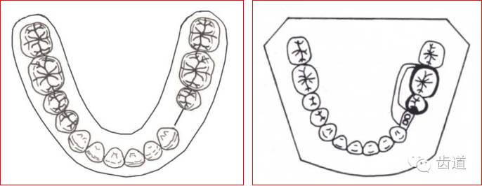 可摘局部义齿的肯氏kennedy分类及设计
