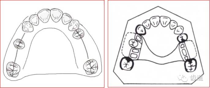 可摘局部义齿的肯氏kennedy分类及设计