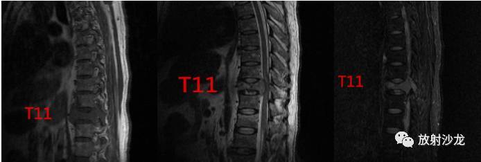 脊椎T11位置真人图图片