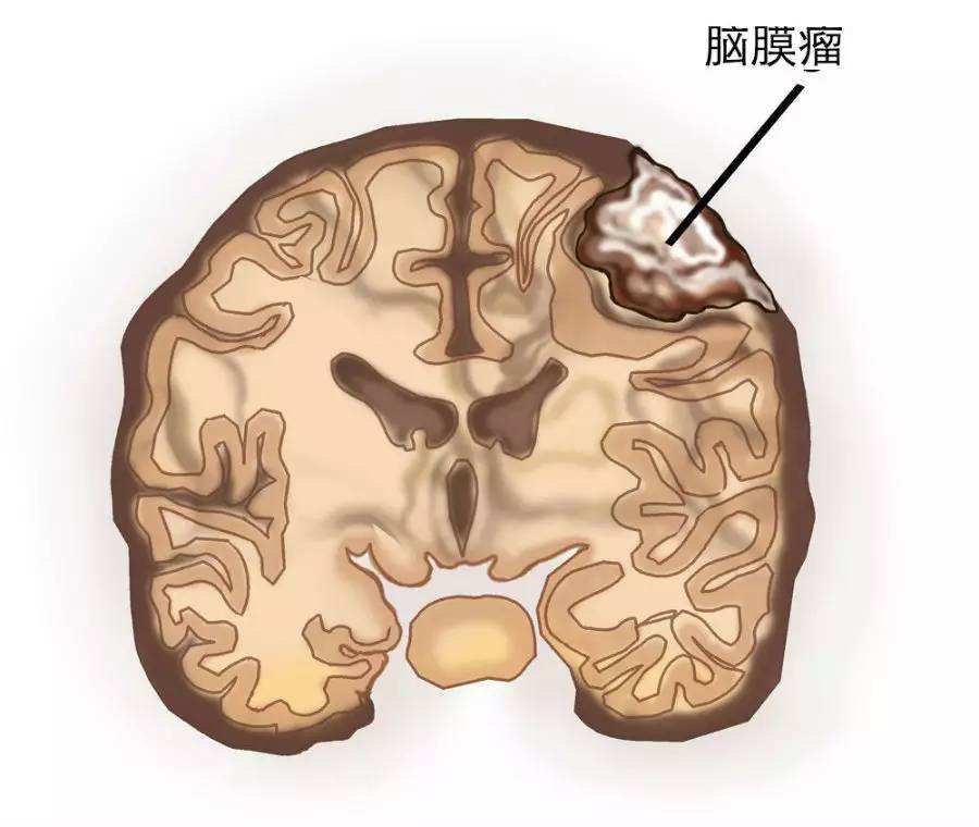 脑膜瘤示意图图片