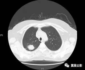 【影像病例】周围型肺癌的鉴别诊断