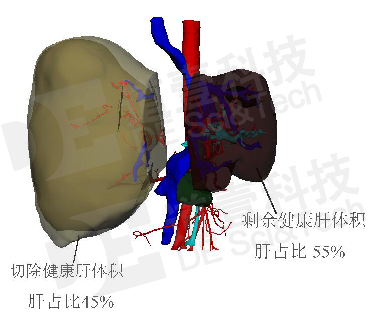 通过道壹科技医学三维重建,清晰显示肿瘤与肝脏,肝静脉,肝门静脉,肝