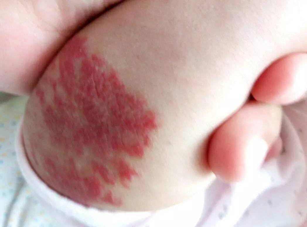 婴儿常见的血管瘤图片图片