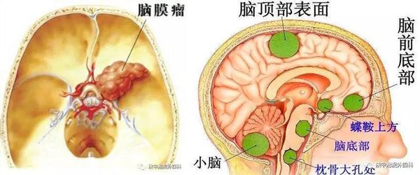 脑膜瘤位置图解图片