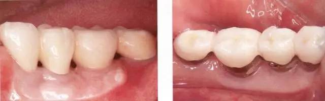 【种植与牙周组织】种植体周围角化龈的获得时期与方法
