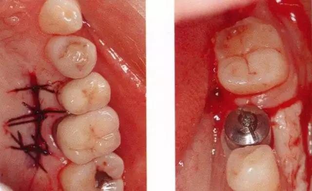 【种植与牙周组织】种植体周围角化龈的获得时期与方法