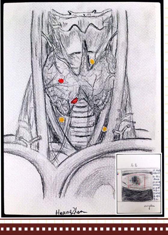 甲状腺结节管理黄镇医生手绘图文科普系列(6)