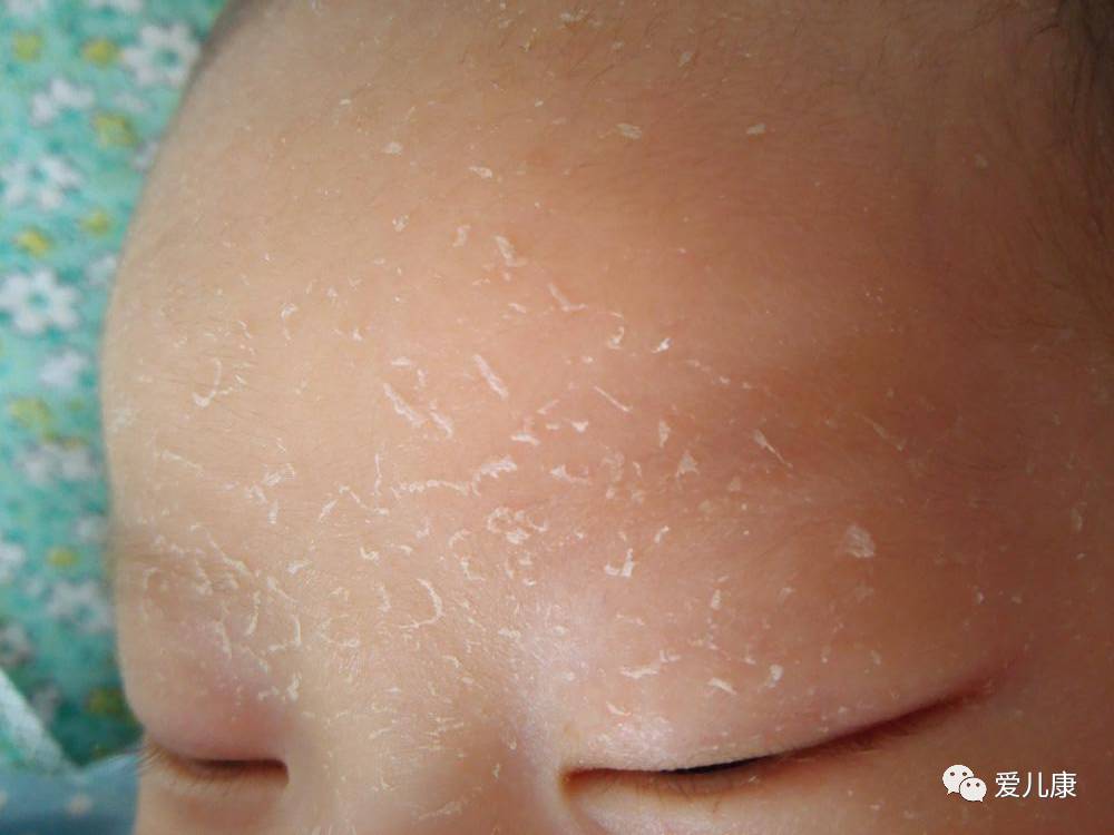 专家在线丨宝宝头面部怎么会出现鱼鳞状的干皮?