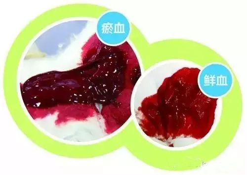 瘀血有两种,一种是一出体外,立刻凝固成果冻状;另一种是糖稀状的粘稠