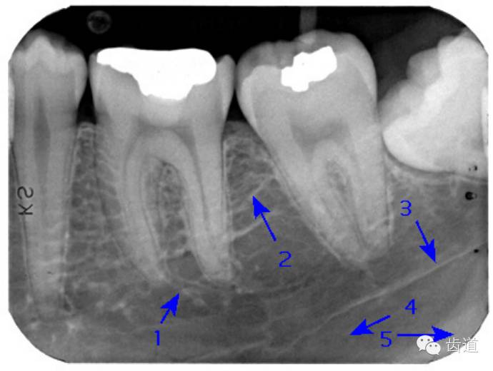 牙根吸收x光片图片