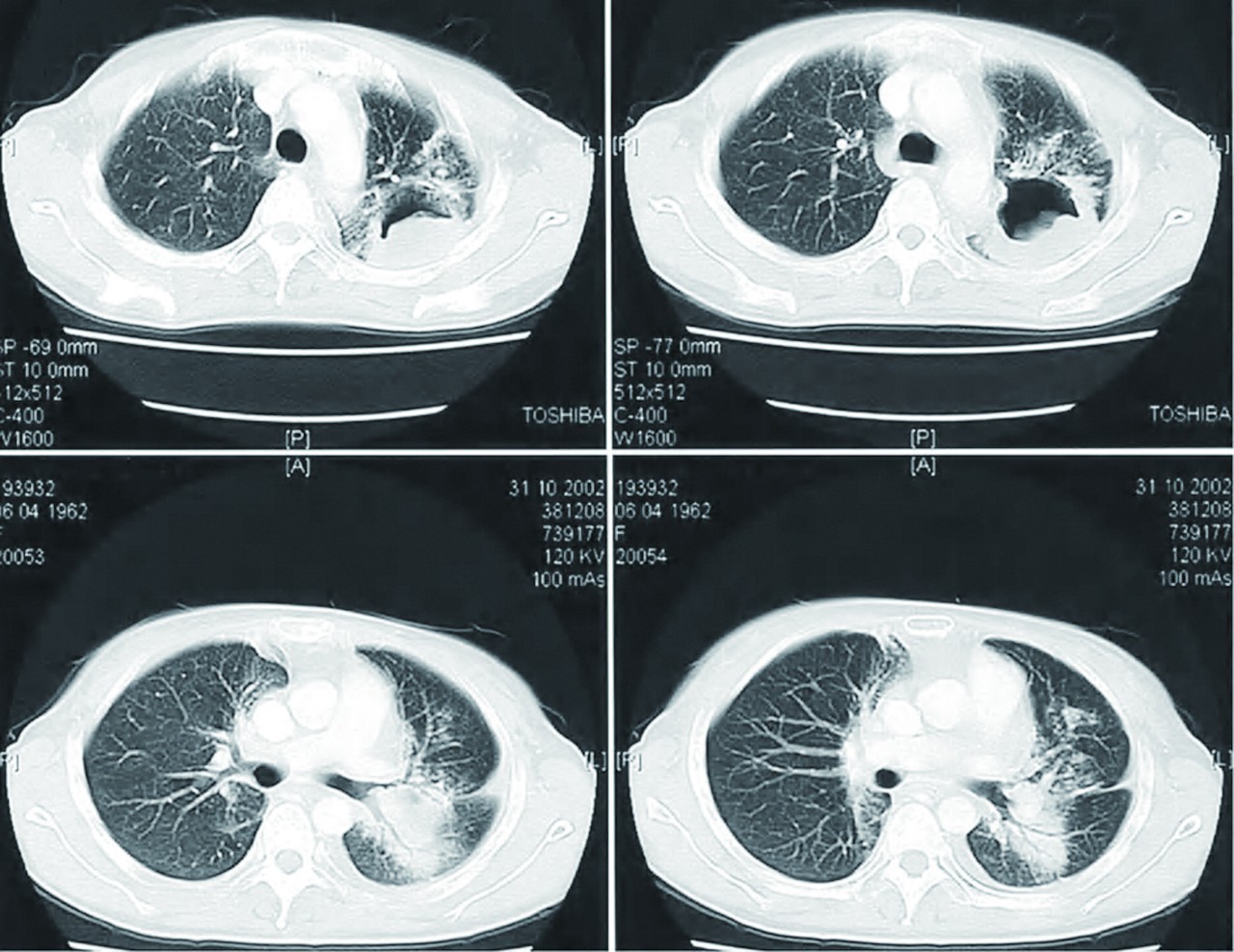 肺脓肿镜下图图片