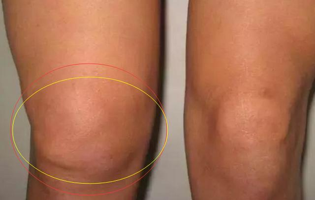 膝关节肿胀疼痛磨损有骨刺简单有效防治方法