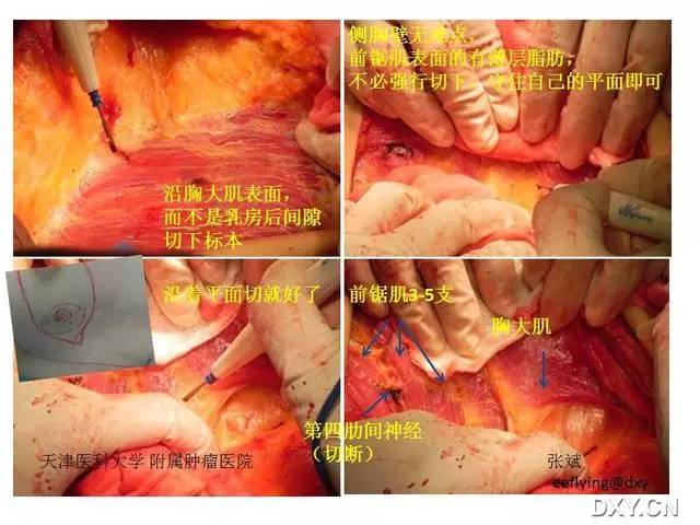 乳腺癌手术过程图解图片
