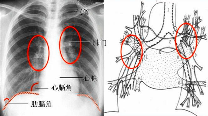 主动脉肺动脉窗图片